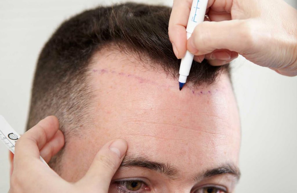 Greffe cheveux homme Tunisie