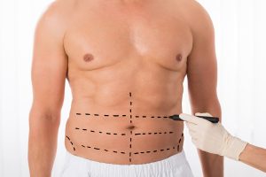 abdominoplastie esthetique Homme Tunisie